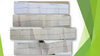 Grand round 11/12/2022.(pericardial effusion and Tamponade)(why?)