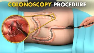 How Colonoscopy Procedure Is Performed? 3d animation