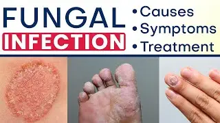 ✅ Fungal Infection क्या और कैसे होता है? ✅ Fungal Infection Symptoms, Causes and Treatment in Hindi
