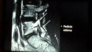 Spine Lecture: Spondylolysis