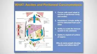 2017 FREE Stomach Cancer Webinar - Ascites and Peritoneal Disease