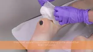 PICO 7 Dressing removal with presence of wound filler