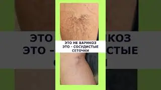 ГДЕ ВАРИКОЗ?