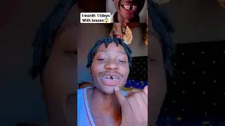 My Teeth shifted in just 1 Month with Braces 