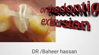 orthodontic extrusion demo (how to gain ferrule by ortho )