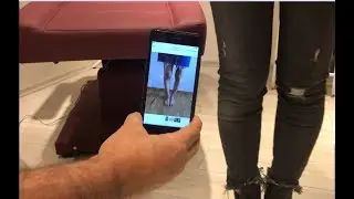 Çarpık Bacak Estetiği Sonrası