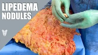 Lipedema Nodules Discussion | Total Lipedema Care