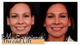 Thread Lift Review [My Experience]  Nova PDO Threads for NonSurgical Facelift