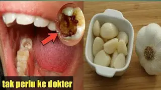 HANYA 5 MENIT SAKIT GIGI SEMBUH TOTAL( CARA AMPUH MENGOBATI SAKIT GIGI) ULAT GIGI HILANG SEMUA