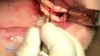 Daina Center - Partially Impacted Wisdom Tooth Extraction