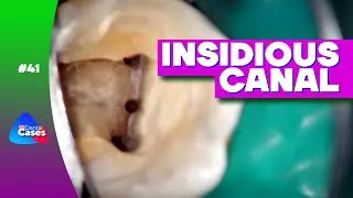 Insidious canal | BG Dental Cases #41  @BeloGrad academy ​