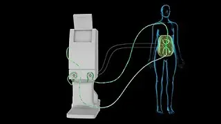 Quimioterapia intraperitoneal caliente (HIPEC)