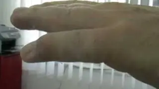 Mallet finger injury