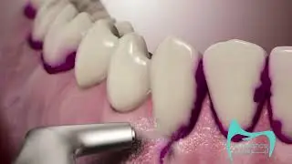 رائحة الفم بعد  ( الفينير ) ما طريقة علاجها Bad breath after  veneers. What is the treatment?