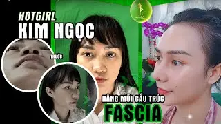 Kết quả nâng mũi cấu trúc Fascia - Liệu có hoàn hảo?