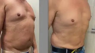 Le iene Italia 1 - chirurgia estetica - Liposuzione addome.