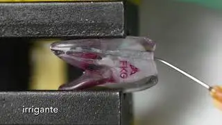 Ritrattamento con solvente con XP Endo Rise di FKG
