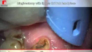 GINGIVECTOMY Fotona Lightwalker ErYAG laser