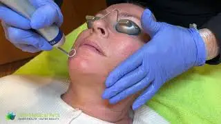 PicoWay Laser Facial at Well Medical Arts in Seattle