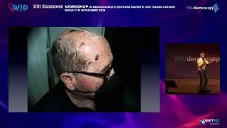 XIII Workshop - G. Argenziano - Update gestione tumori cutanei
