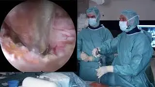 Central canal stenosis decompression performed by Prof. Dr. Christoph Siepe, Munich