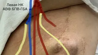 Артериовенозная фистула