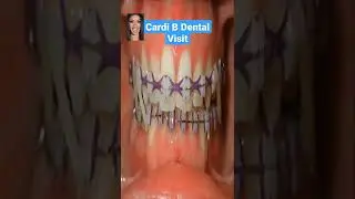 Cardi B teeth Before and After Braces 😝 
