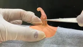 Treatment Of Blackhead Removal at Lam Dep Spa #053