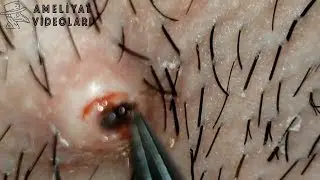Kıl Dönmesi Böylesini görmediniz - Hair rotation #blackheads