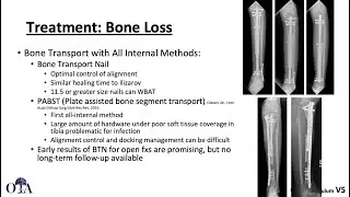 Tibia shaft fractures - 3 of 3