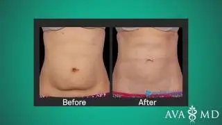 Fat Reduction with CoolSculpting