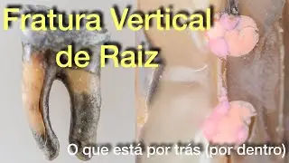 Fratura Vertical de Raiz (VRF - Vertical Root Fracture)