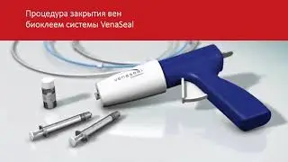 Закрытие вен биоклеем системы VenaSeal