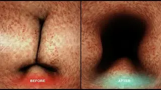 BPH 2 - prostate and urinary symptoms