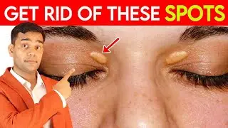 Get Rid Of These Spots | Fat Under Eyes |  Xanthelasma |  Natural Remedies - Dr. Vivek Joshi