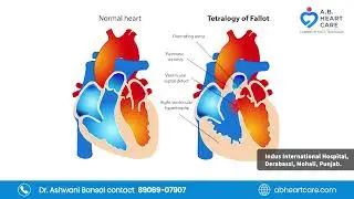Blue baby high risk heart surgery, cyanosis completely improved