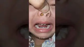 Something Stuck In Nose 😵  | How Doctor Remove It |        