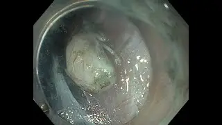 Submucosal tunneling endoscopic resection for a gastric submucosal tumor.
