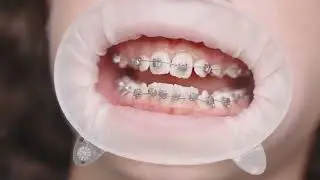 SLX 3D Positioning and Placement with Dr. Colino