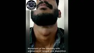 Thyroglossal Cyst Clinical Diagnosis