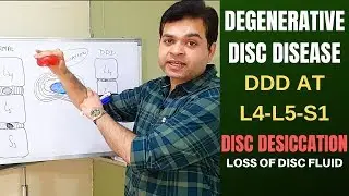 Degenerative Disc Disease (DDD) L4 L5, L5 S1-Disc Desiccation- Disc Degeneration Disease Treatment