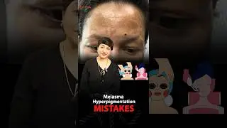 Melasma and Hyperpigmentation Treatment Mistakes | Avoid Common Mistakes #skincare #melasma