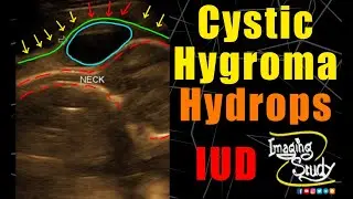 Cystic Hygroma || Hydrops Fetalis || Ultrasound || Anomaly || Case 214