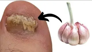 How GARLIC Remove FUNGUS INFECTION?