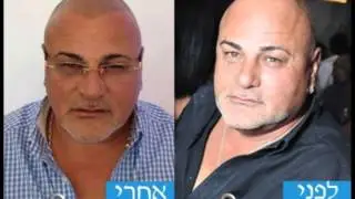 הדמייתשיער הדמיית שיער לגברים מחירים המלצות פורום תמונות - סיטי®