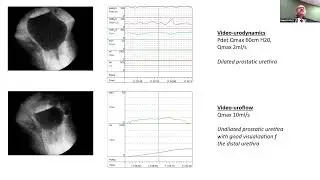 Urodynamics   Interpretation and Reporting by Dr Sanjay Sinha
