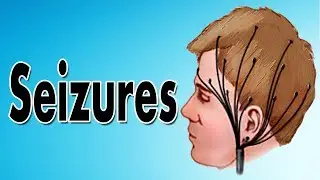Epilepsy