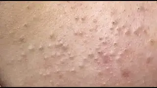 Acne treatment under the skin (P.1) #HoangMySpa116