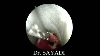 arête de poisson larynx enfant