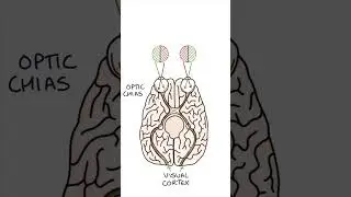 Bitemporal Hemianopia 